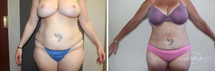 Patient 2469, Liposuction before and after photos Liposuction before and after photos in Boston, MA, Patient 2469