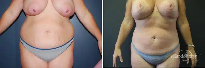 Liposuction Before and After Photos in Boston, MA, Patient 2476