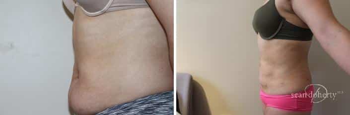 Patient 2462, Liposuction before and after photos Liposuction before and after photos in Boston, MA, Patient 2462