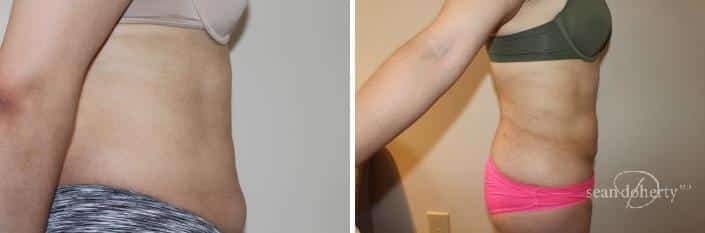 Patient 2462, Liposuction before and after photos Liposuction before and after photos in Boston, MA, Patient 2462
