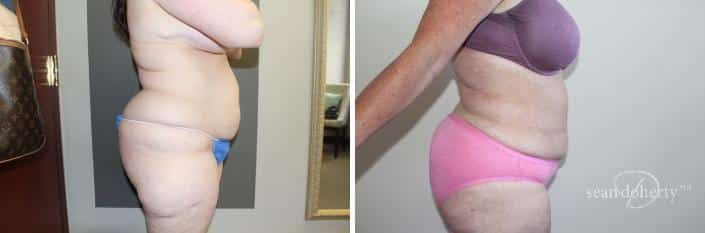 Patient 2469, Liposuction before and after photos Liposuction before and after photos in Boston, MA, Patient 2469
