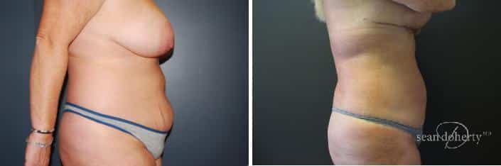 Patient 2476, Liposuction Before and After Photos Liposuction Before and After Photos in Boston, MA, Patient 2476