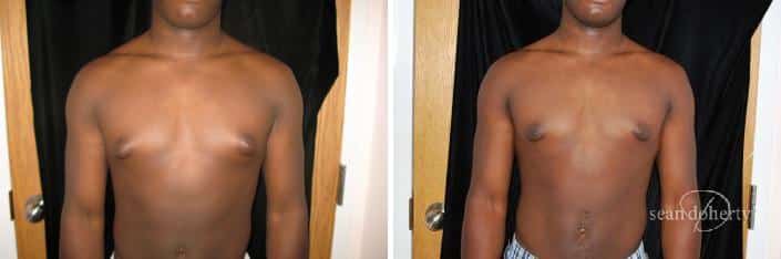 Patient 2489, Gynecomastia Before and After Photos Gynecomastia Before and After Photos in Boston, MA, Patient 2489