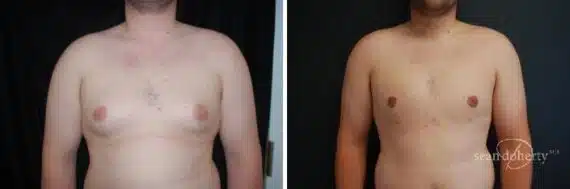 Gynecomastia Before and After Photos in Boston, MA, Patient 2509