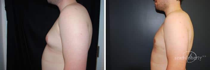 Gynecomastia Before and After Photos in Boston, MA, Patient 2509