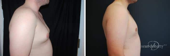 Gynecomastia Before and After Photos in Boston, MA, Patient 2509