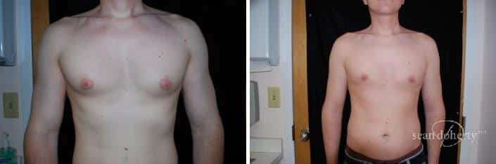 Gynecomastia Before and After Photos in Boston, MA, Patient 2519