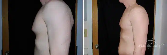 Gynecomastia Before and After Photos in Boston, MA, Patient 2519