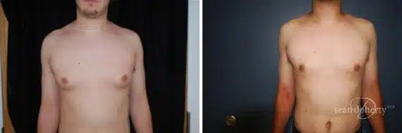 Gynecomastia Before and After Photos in Boston, MA, Patient 2526