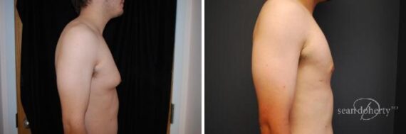 Gynecomastia Before and After Photos in Boston, MA, Patient 2526