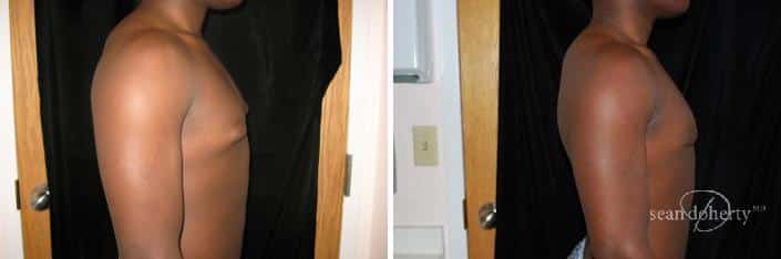Patient 2489, Gynecomastia Before and After Photos Gynecomastia Before and After Photos in Boston, MA, Patient 2489
