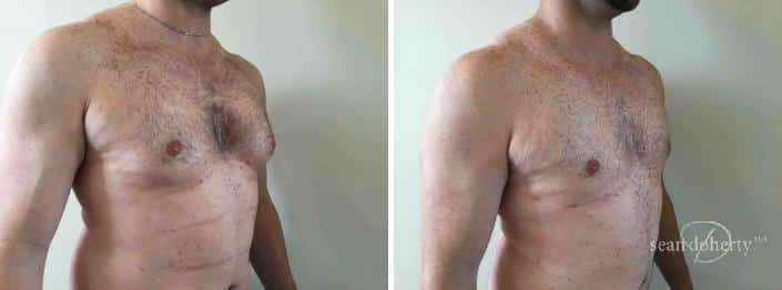 Patient 2533, Gynecomastia before and after photos Gynecomastia before and after photos in Boston, MA, Patient 2533