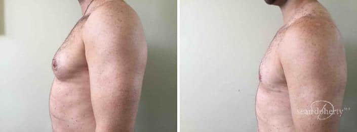 Patient 2533, Gynecomastia before and after photos Gynecomastia before and after photos in Boston, MA, Patient 2533