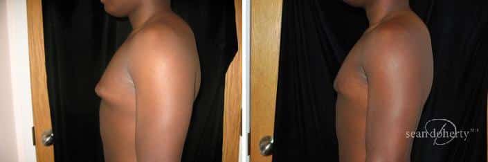 Patient 2489, Gynecomastia Before and After Photos Gynecomastia Before and After Photos in Boston, MA, Patient 2489
