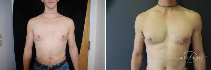 Gynecomastia Before and After Photos in Boston, MA, Patient 2496