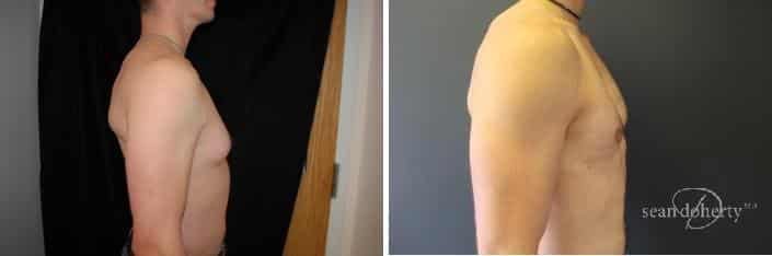 Gynecomastia Before and After Photos in Boston, MA, Patient 2496