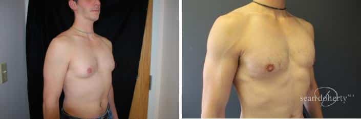 Gynecomastia Before and After Photos in Boston, MA, Patient 2496