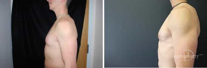 Gynecomastia Before and After Photos in Boston, MA, Patient 2496