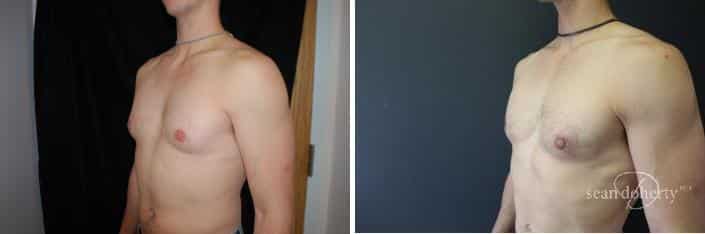 Gynecomastia Before and After Photos in Boston, MA, Patient 2496