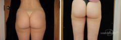 Liposuction Before and After Photos in Boston, MA, Patient 2486