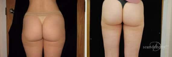 Liposuction Before and After Photos in Boston, MA, Patient 2486