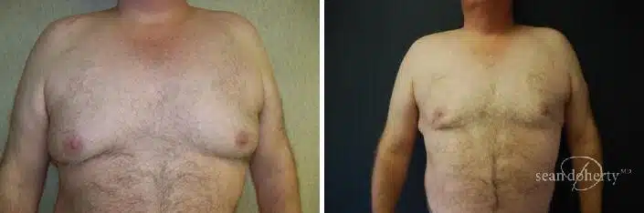 Gynecomastia Before and After Photos in Boston, MA, Patient 2516