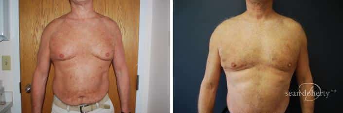 Patient 2551, Male Liposuction Before and After Photos Male Liposuction Before and After Photos in Boston, MA, Patient 2551