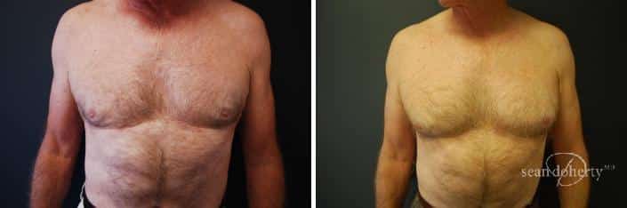 Patient 2562, Male Liposuction Before and After Photos Male Liposuction Before and After Photos in Boston, MA, Patient 2562