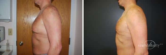 Patient 2551, Male Liposuction Before and After Photos Male Liposuction Before and After Photos in Boston, MA, Patient 2551