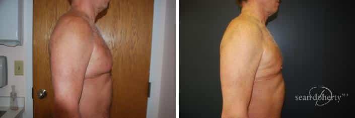 Patient 2551, Male Liposuction Before and After Photos Male Liposuction Before and After Photos in Boston, MA, Patient 2551