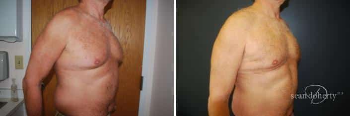 Patient 2551, Male Liposuction Before and After Photos Male Liposuction Before and After Photos in Boston, MA, Patient 2551