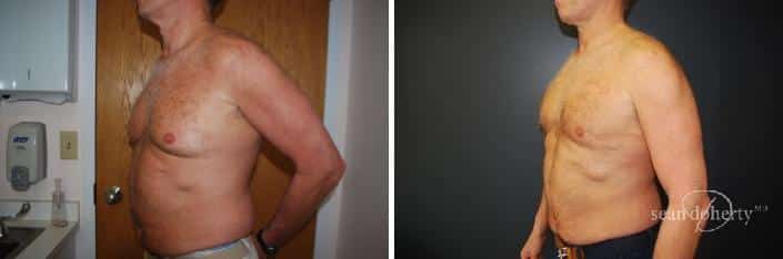 Patient 2551, Male Liposuction Before and After Photos Male Liposuction Before and After Photos in Boston, MA, Patient 2551