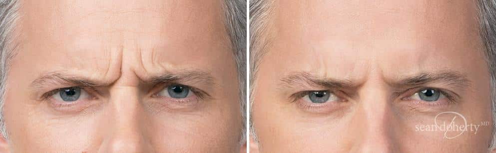 Patient 2602, Botox before and after photos Botox before and after photos in Boston, MA, Patient 2602