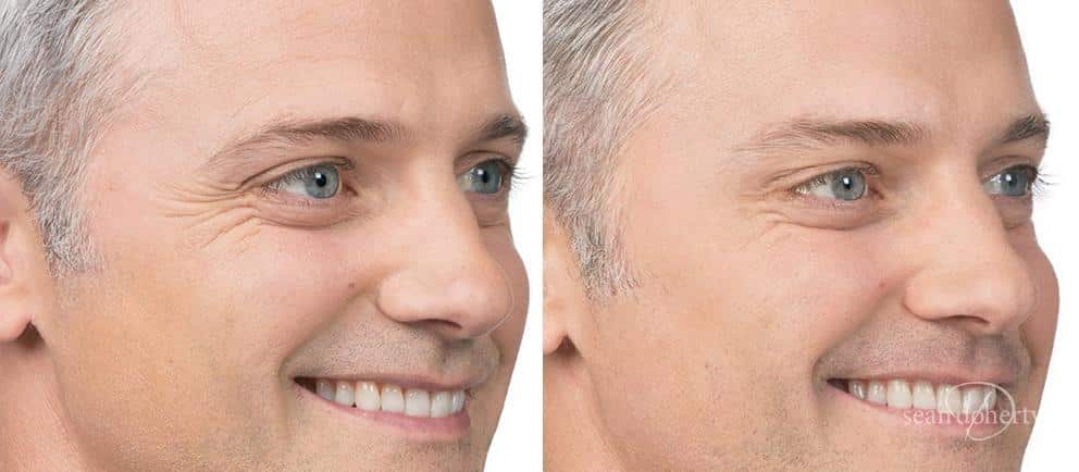 Patient 2602, Botox before and after photos Botox before and after photos in Boston, MA, Patient 2602