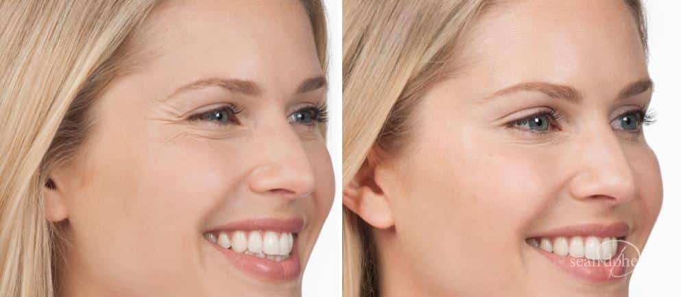 Patient 2607, Botox before and after photos Botox before and after photos in Boston, MA, Patient 2607