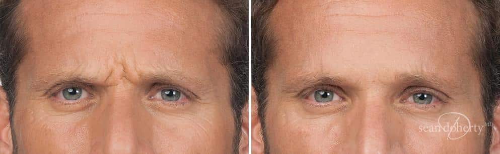 Patient 2612, Botox before and after photos Botox before and after photos in Boston, MA, Patient 2612