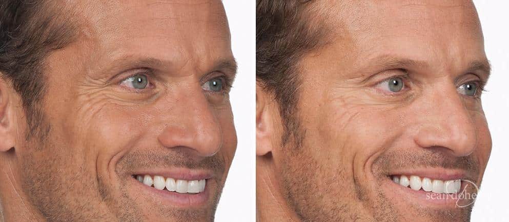 Patient 2612, Botox before and after photos Botox before and after photos in Boston, MA, Patient 2612