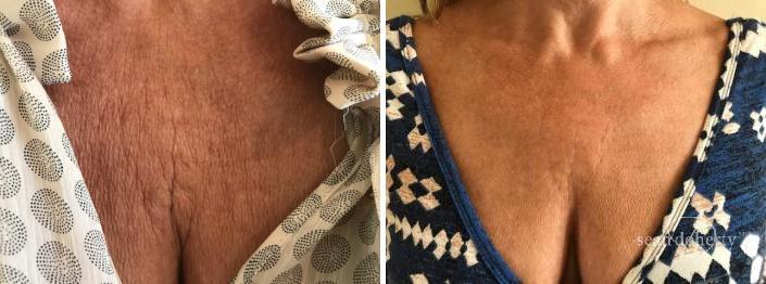 Patient 2579, Botox before and after photos Botox before and after photos in Boston, MA, Patient 2579