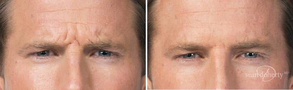 Patient 2582, Botox before and after photos Botox before and after photos in Boston, MA, Patient 2582