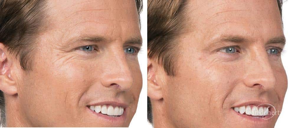 Patient 2582, Botox before and after photos Botox before and after photos in Boston, MA, Patient 2582
