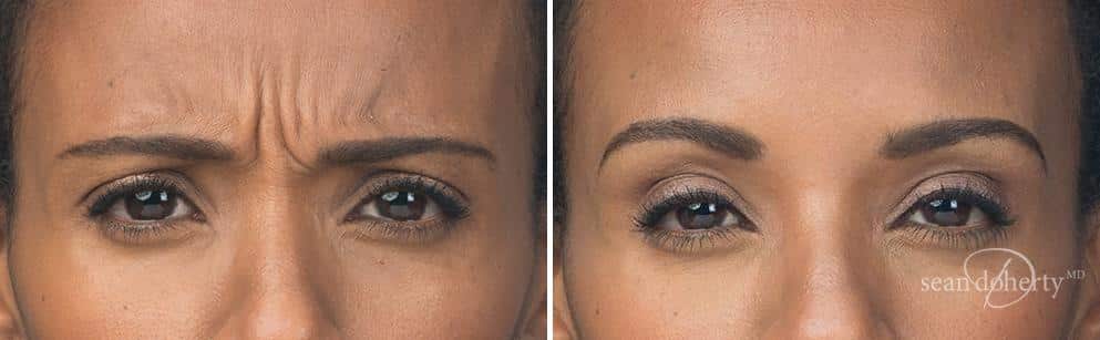 Patient 2587, Botox before and after photos Botox before and after photos in Boston, MA, Patient 2587