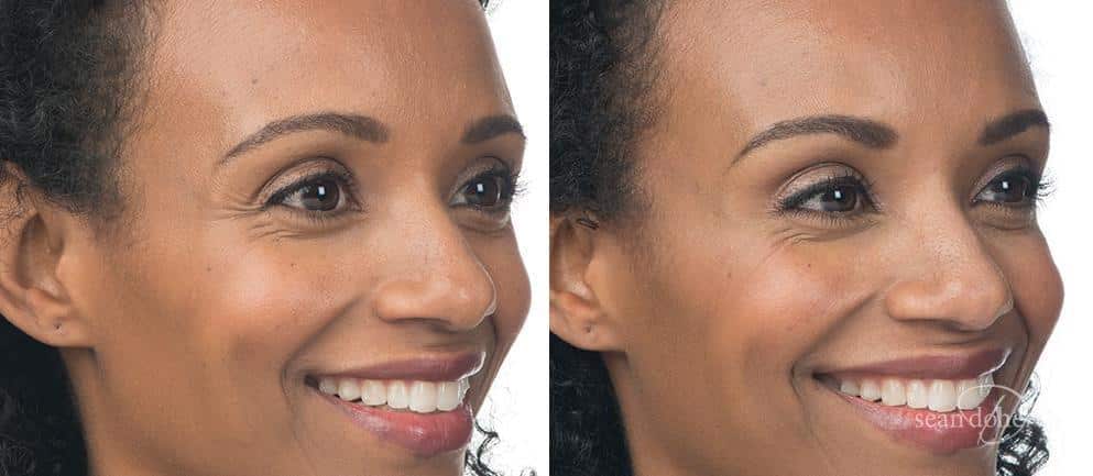 Patient 2587, Botox before and after photos Botox before and after photos in Boston, MA, Patient 2587