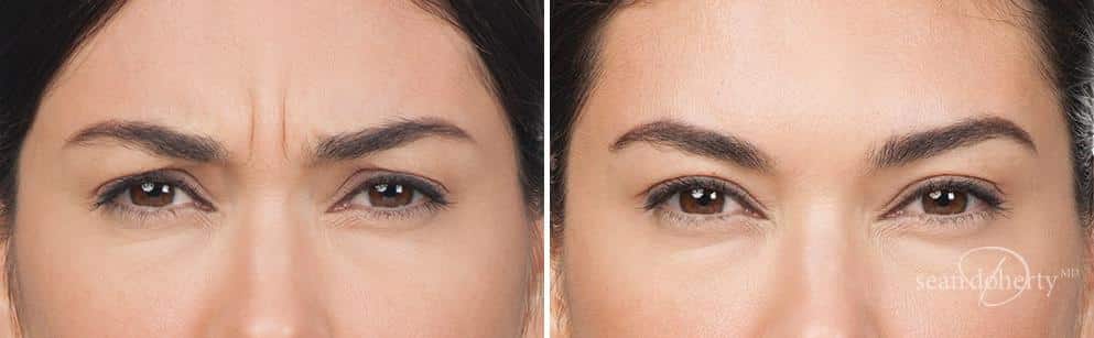 Patient 2592, Botox before and after photos Botox before and after photos in Boston, MA, Patient 2592
