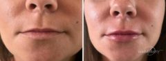 Lip Augmentation Before and After Photos in Boston, MA, Patient 2622