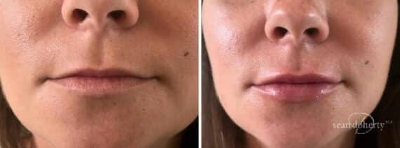 Lip Augmentation Before and After Photos in Boston, MA