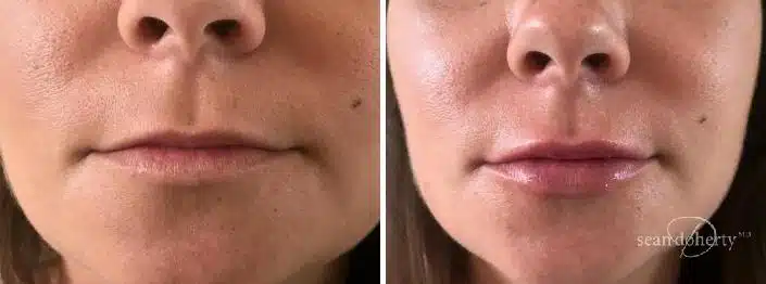 Lip Augmentation Before and After Photos in Boston, MA, Patient 2622