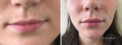 Lip Augmentation Before and After Photos in Boston, MA, Patient 2625