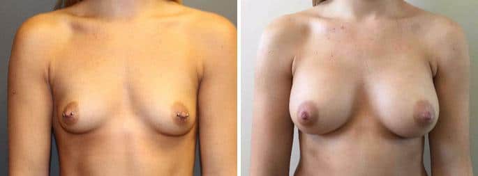 Patient 3193, Breast Augmentation before and after photos Breast Augmentation before and after photos in Boston, MA, Patient 3193