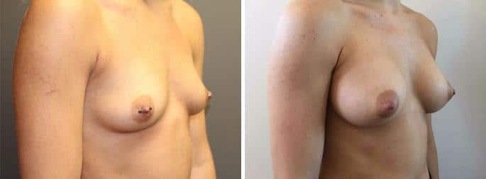 Patient 3193, Breast Augmentation before and after photos Breast Augmentation before and after photos in Boston, MA, Patient 3193