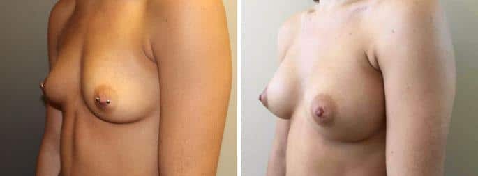 Patient 3193, Breast Augmentation before and after photos Breast Augmentation before and after photos in Boston, MA, Patient 3193
